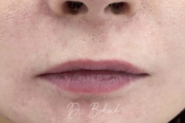 botox zkušenosti - před