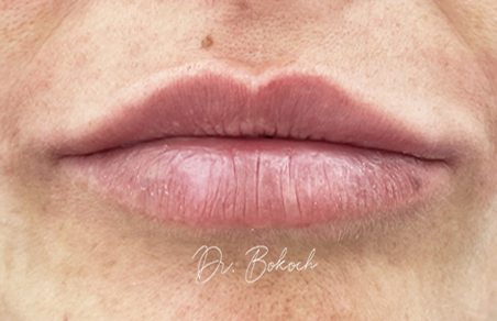 botox zkušenosti - po