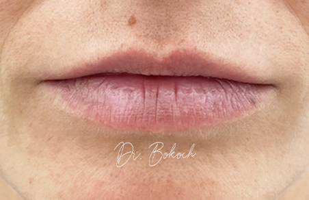 botox zkušenosti - před